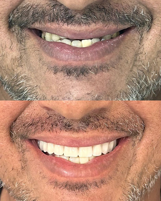 Antes-e-Depois